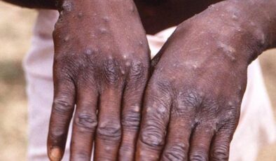 Afrika ülkesinde M çiçeği alarmı! Vakalar da can kaybı da arttı